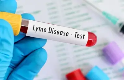 Types Of Lyme Disease Tests